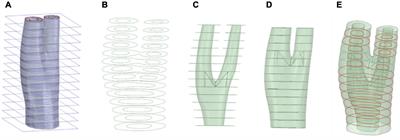 Development of a Collagen Fibre Remodelling Rupture Risk Metric for Potentially Vulnerable Carotid Artery Atherosclerotic Plaques